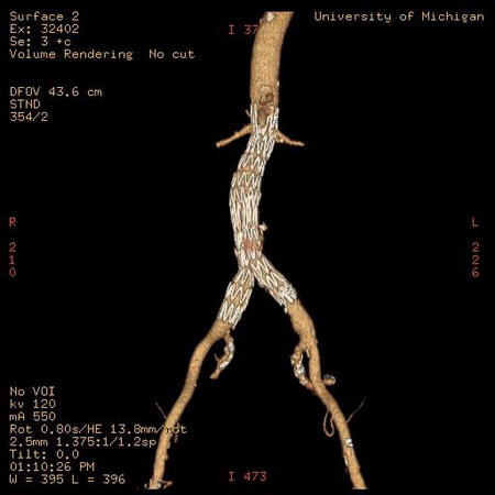 Endovascular aneurysm repair (EVAR)
