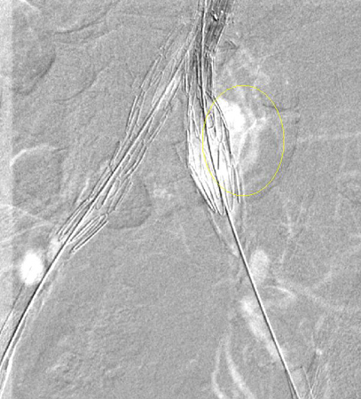 Type I endoleak at the distal left iliac anastomosis (leak encircled)