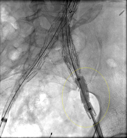 Extension stent graft deployed for the same type I endoleak (encircled)