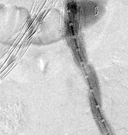 Resolution of the type I endoleak resolved after extension deployed
