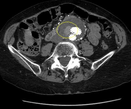 Endofuga tipo II (marcada con un círculo) descubierta en seguimiento con TC