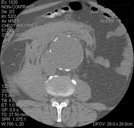 Aneurisma da aorta abdominal: tomografia computadorizada (TC) de um aneurisma da aorta abdominal roto