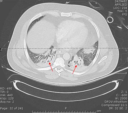 Hospital-acquired pneumonia (non COVID-19) images