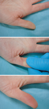 Sepsis in adults images