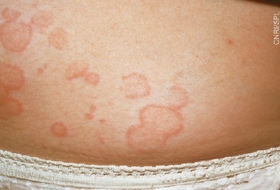 Urticaria