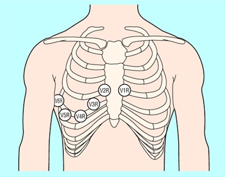 Position of right precordial ECG leads V3R and V4R