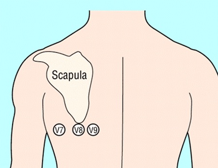 Unstable angina images