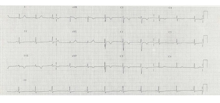 ECG showing T wave inversion in leads V1-V4, III and aVF.
