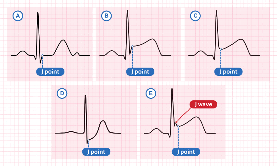 Identifying the J point on the ECG