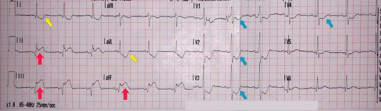 Inferoposterior STEMI example I