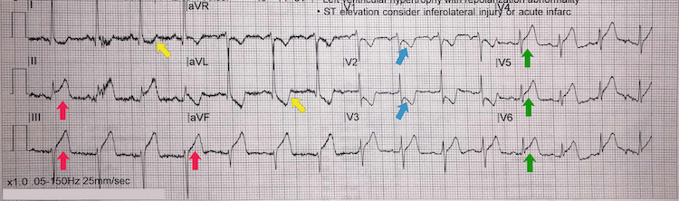 Inferoposterolateral STEMI example I