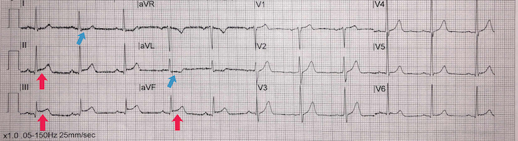 Inferior STEMI example I