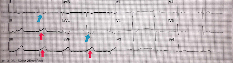 Inferior STEMI example II