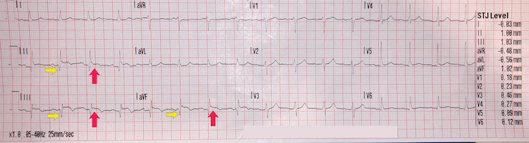 Inferior STEMI example III