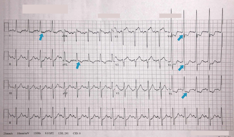 Left ventricular hypertrophy example II