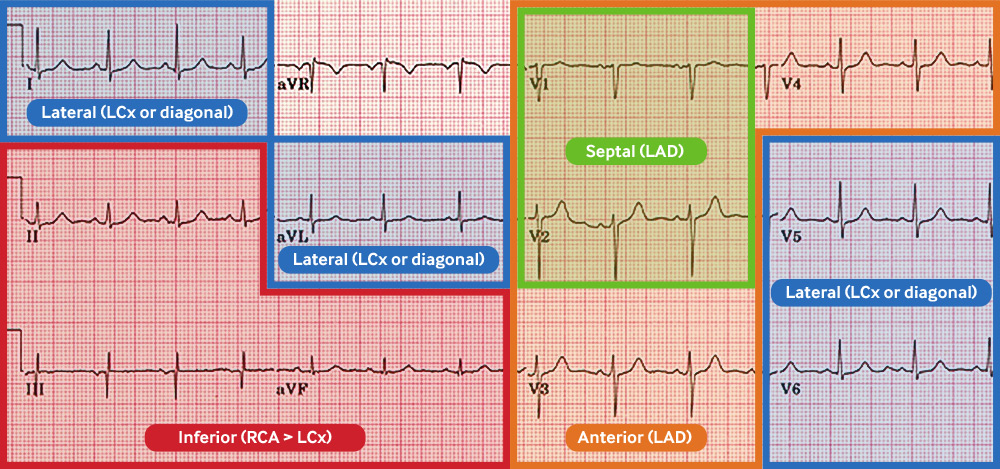 Coronary anatomy and ECG leads