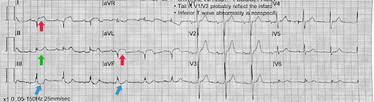 High lateral STEMI