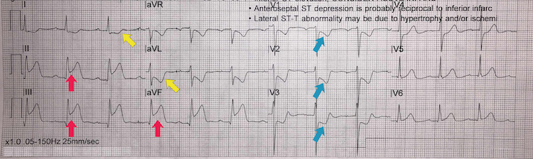 Inferoposterior STEMI example II