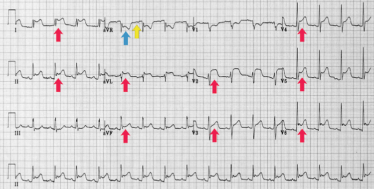 Acute pericarditis