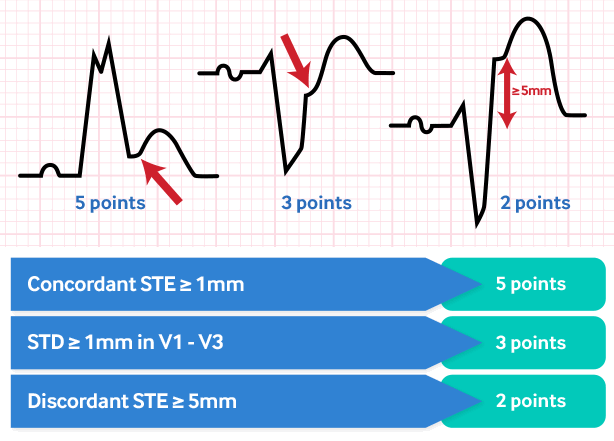 Sgarbossa criteria for MI in the presence of LBBB