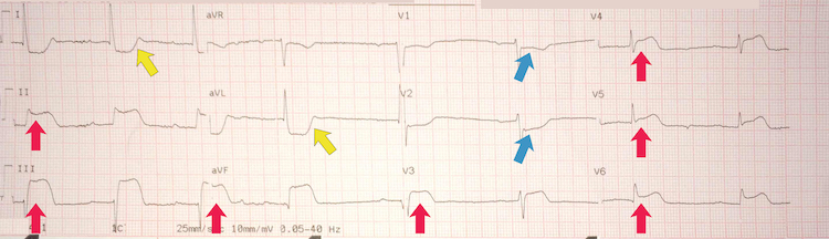 Inferoposterolateral STEMI example III