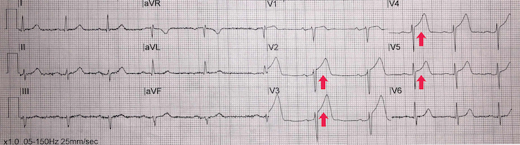 Anteroseptal STEMI example I