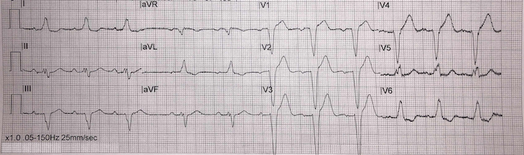 Left bundle branch block example I
