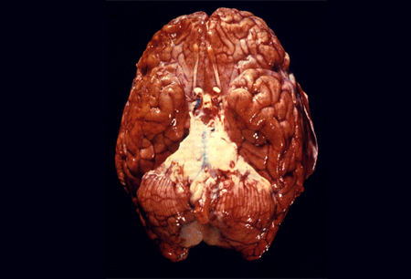 Bacterial meningitis in adults images