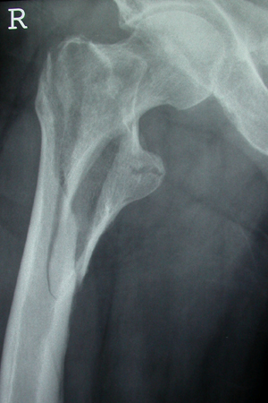 Unstable intertrochanteric fracture on x-ray