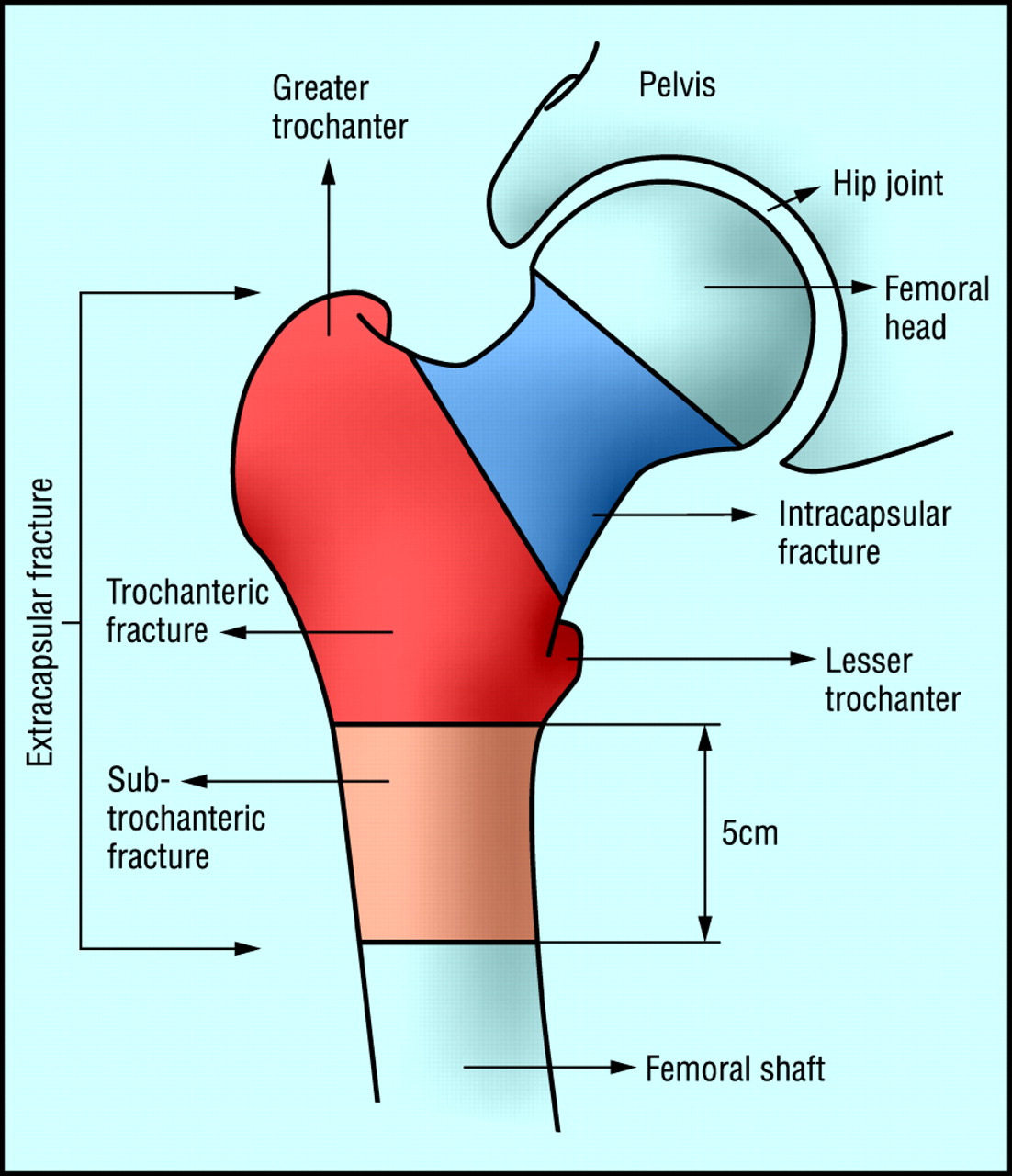 Classification of hip fractures. Fractures in the blue area are intracapsular and those in the red and orange areas are extracapsular