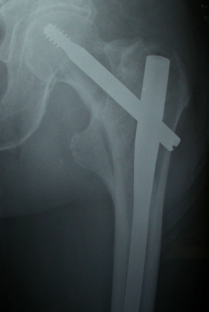 Clavo intramedular (cefalomedular) para el tratamiento de una fractura intertrocantérea inestable