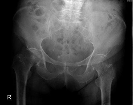 Radiografia pélvica anteroposterior mostrando uma possível fratura intracapsular do quadril esquerdo