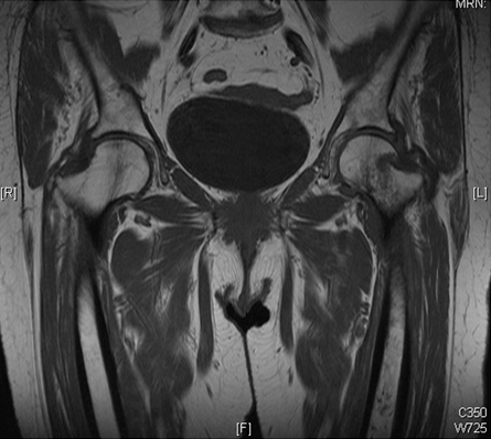 Ressonância magnética mostrando imagem coronal confirmando uma fratura intracapsular do quadril esquerdo