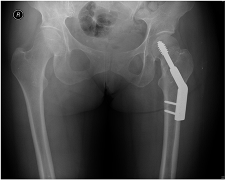 Radiografia pélvica anteroposterior mostrando uma fratura intracapsular esquerda fixada com uma estrutura com parafusos deslizantes de quadril
