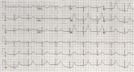 ECG done on admission of a patient with subarachnoid haemorrhage; note peaked, tall T waves (1 of 2)