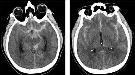 Subarachnoid haemorrhage images