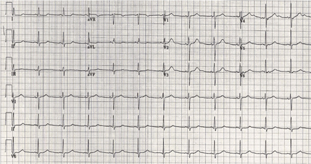 Same patient, 24 hours later; note normalisation of T waves (2 of 2)