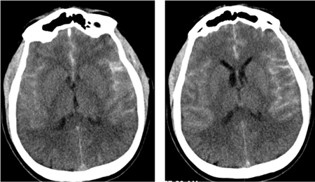 CT brain showing subarachnoid haemorrhage from a ruptured posterior cerebral artery aneurysm (2 of 2)
