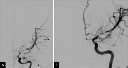 Severe vasospasm of distal left internal carotid artery and proximal middle and anterior cerebral arteries before (A) and after (B) intra-arterial infusion of nicardipine and transluminal balloon angioplasty