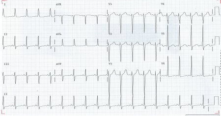 ECG showing left ventricular hypertrophy with sinus tachycardia
