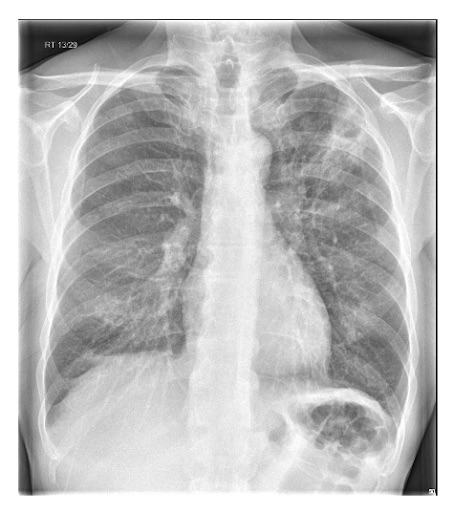 Chest radiograph showing left upper lobe cavitating pneumonia