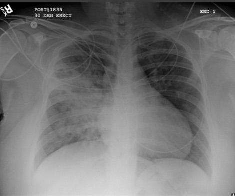 Increased opacification of the right perihilar region and superior segment of the right lower and upper lobes consistent with worsening aspiration pneumonia