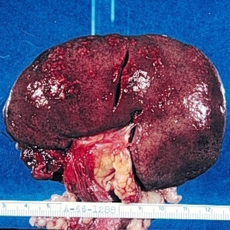 External surface of the kidney with multifocal irregular, whitish, raised lesions consisting of purulent exudates