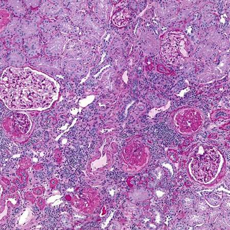 Interstitial infiltrates and oedema in acute pyelonephritis. Some glomeruli also show evidence of a second kidney disease, focal glomerulosclerosis