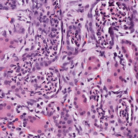 Higher magnification: polymorphonuclear cell infiltrates in and around the renal tubules