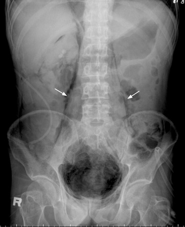 Psoas muscle shadow enhanced by retroperitoneal air in emphysematous pyelonephritis
