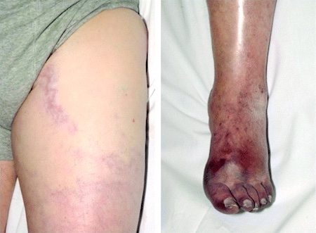 Deep vein thrombosis images