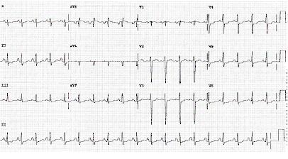 ECG que muestra depresión inferolateral del segmento ST