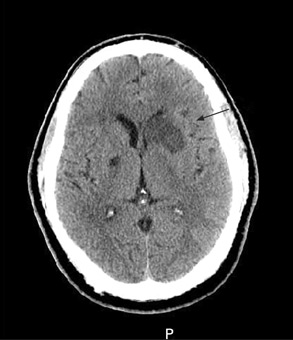 Ischaemic stroke images