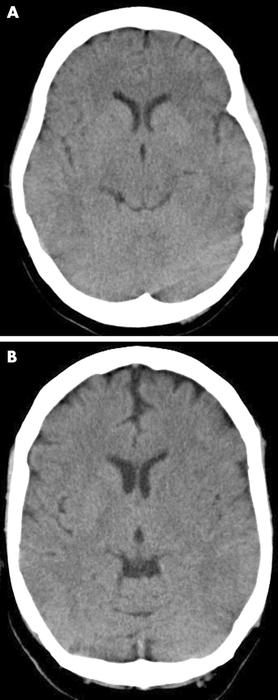 Two examples of early ischaemic changes on CT in sub-three hour ischaemic stroke. (A) Acute left middle cerebral artery (MCA) ischaemia with loss of insular ribbon, and hypodensity of tail of lentiform nucleus. (B) Similar changes in a different patient, with hypodensity of entire lentiform nucleus, some hemispheric sulcal effacement, and compression of lateral ventricle caused by hypodensity of caudate head